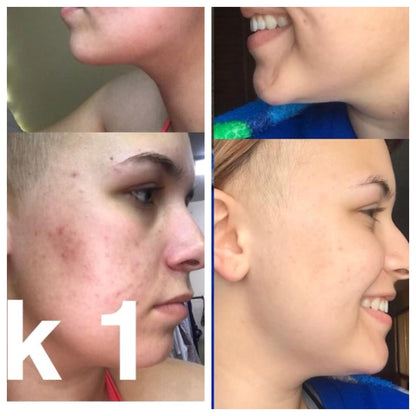 BMU Organic Acne Essential